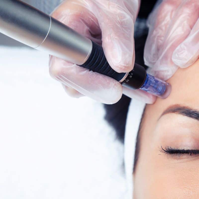 Morpheus8 treatment Faringdon from Lipo Sculpt - Book in today!